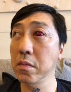 庾澄慶眼睛受傷在微博曬出眼睛受傷的照片 這個受傷的眼睛好嚇人